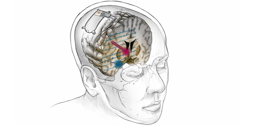 آیا نتایج درمان با تحریک الکتریکی مغز ماندگار خواهد بود؟